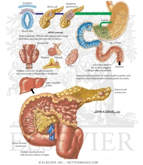 Zollinger-Ellison Syndrome
