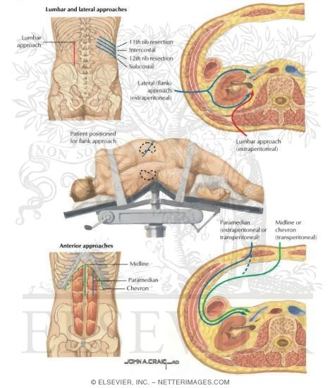 Watermarked preview of labeled image: Surgical Approach to the Kidney