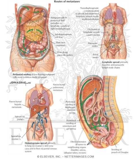 Routes of Spread of Ovarian Cancer