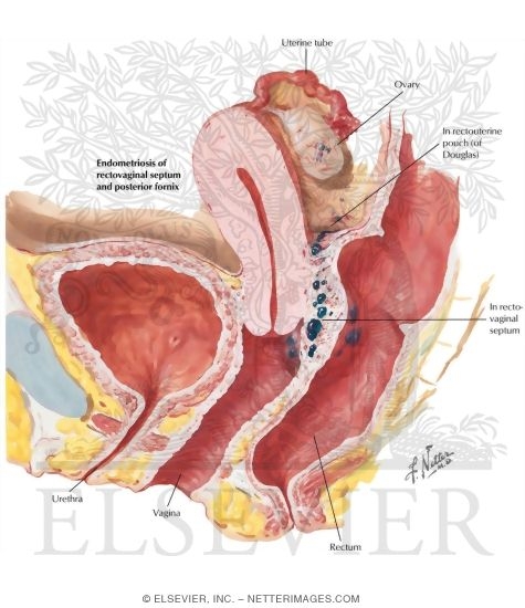 Watermarked preview of labeled image: Endometriosis