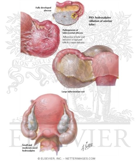 Watermarked preview of labeled image: Chronic Pelvic Inflammatory Disease