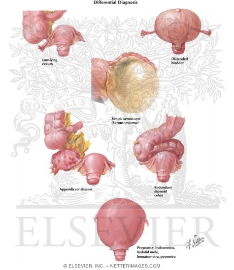 Watermarked preview of labeled image: Ovarian Cysts