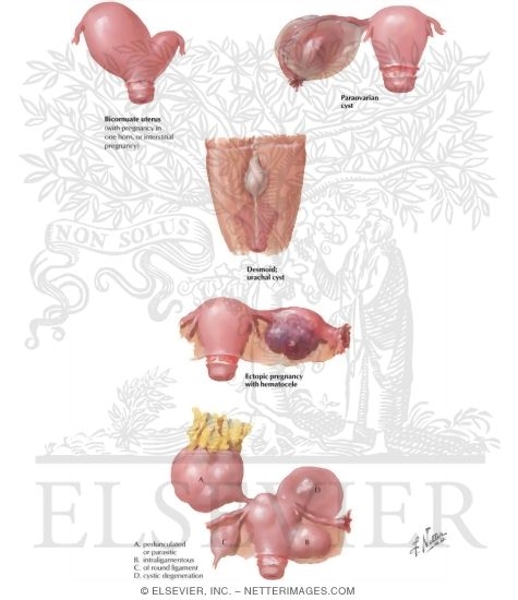 Watermarked preview of labeled image: Ovarian Tumors