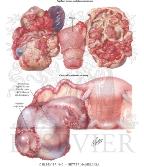 Watermarked preview of labeled image: Ovarian Tumors