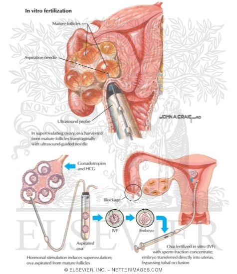 Watermarked preview of labeled image: Assisted Reproduction