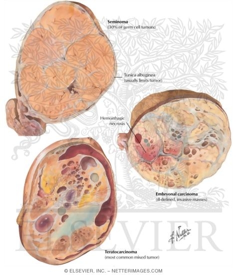 Watermarked preview of labeled image: Testicular Cancer