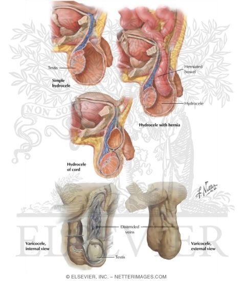 Hydrocele and Varicocele