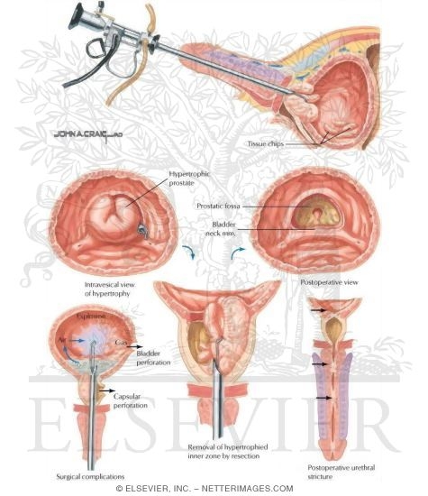 Watermarked preview of labeled image: Transurethral Resection of the Prostate