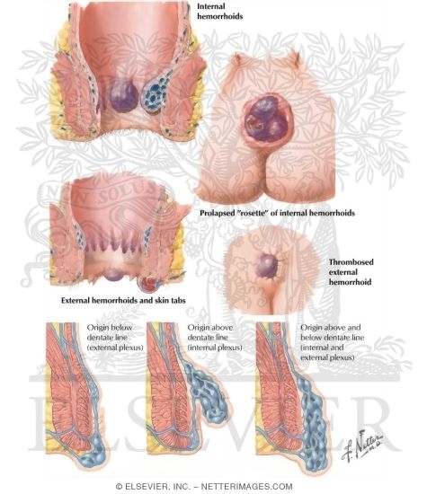 Watermarked preview of labeled image: Hemorrhoids