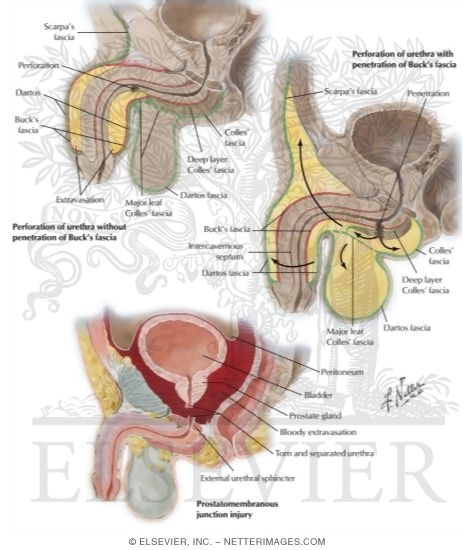 Urine Extravasation