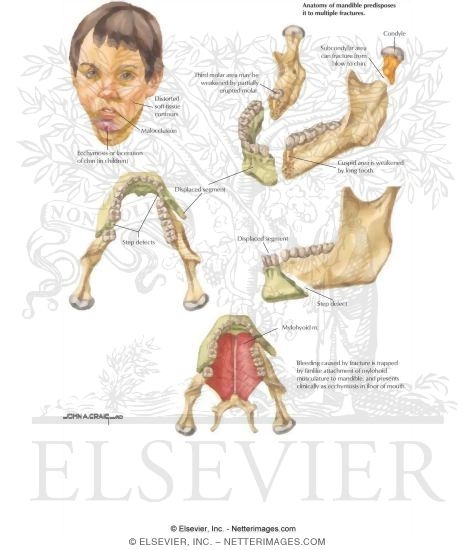 Watermarked preview of labeled image: Mandibular Fractures