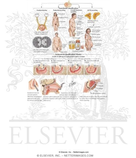 Watermarked preview of labeled image: Pituitary Tumor Resection