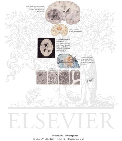 Watermarked preview of labeled image: Gliomas