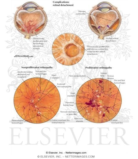 Watermarked preview of labeled image: Diabetic Retinopathy