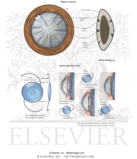 Watermarked preview of labeled image: Cataract