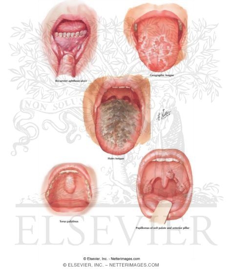 Watermarked preview of labeled image: Common Oral Lesions