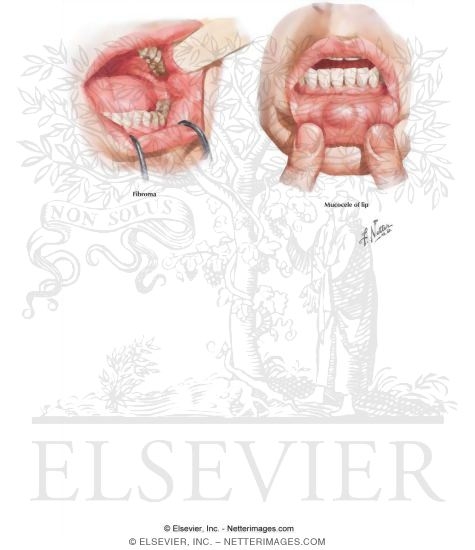 Watermarked preview of labeled image: Common Oral Lesions