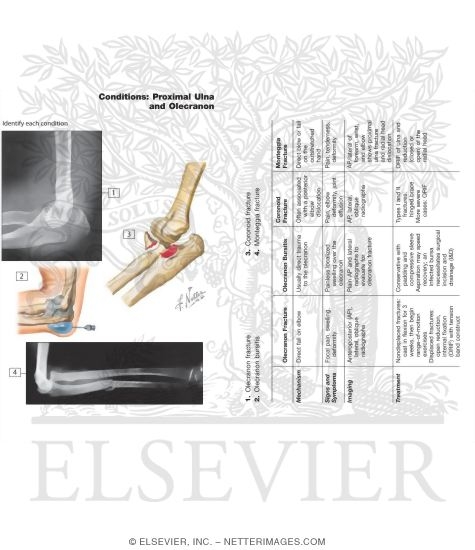Watermarked preview of unlabeled image: Conditions of the Elbow: Proximal Ulna and Olecranon