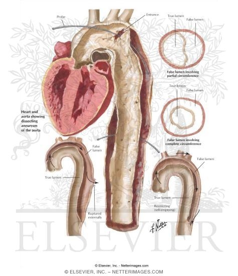 Watermarked preview of labeled image: Aneurysms of the Aorta
