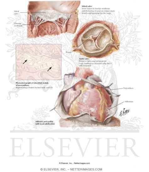 Rheumatic Heart Disease III-Residual Changes of Acute Rheumatic Carditis