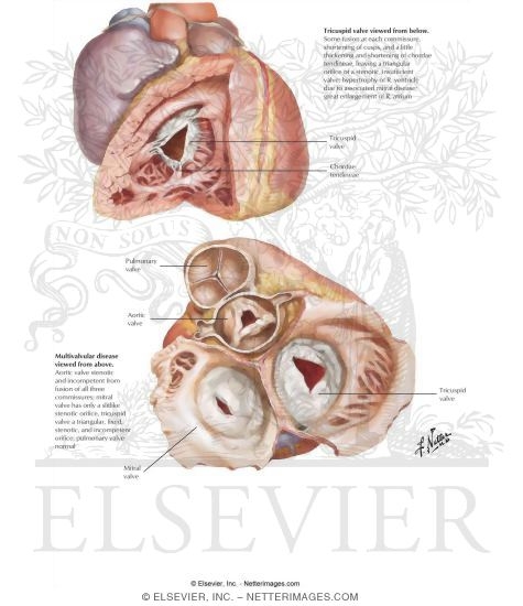 Rheumatic Heart Disease Xii Tricuspid Stenosis And Insufficiency