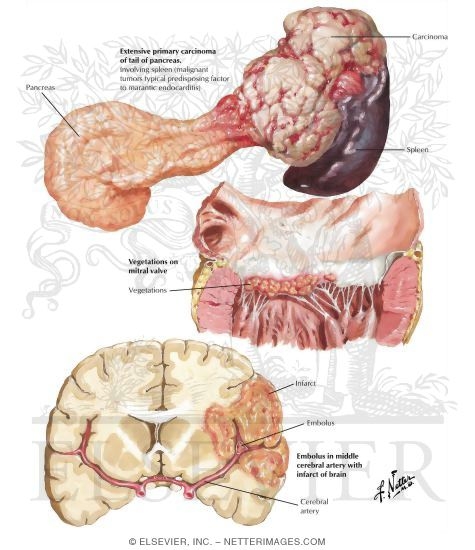 Watermarked preview of labeled image: Marantic Endocarditis