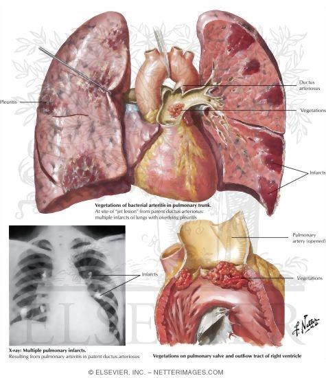 Bacterial Endocarditis IV - Right-Side Involvement