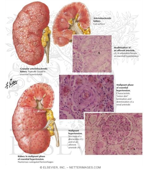 Watermarked preview of labeled image: Kidneys in Hypertension