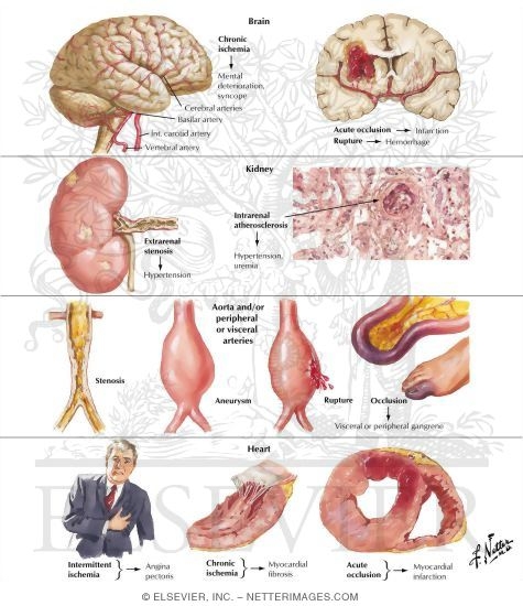 Critical Areas of Atherosclerosis
