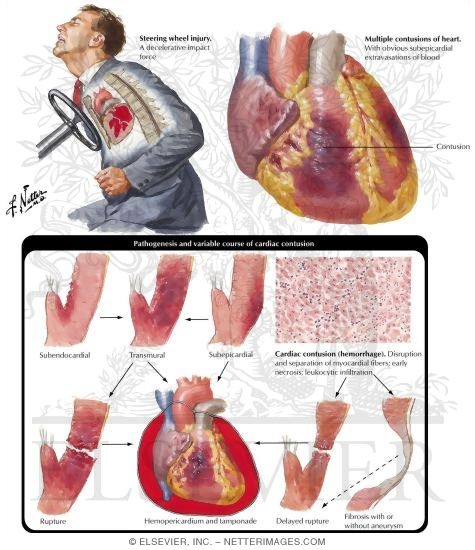 Watermarked preview of labeled image: Nonpenetrating Heart Wounds