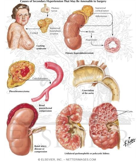 Causes of Secondary Hypertension Possibly Amenable to Surgery