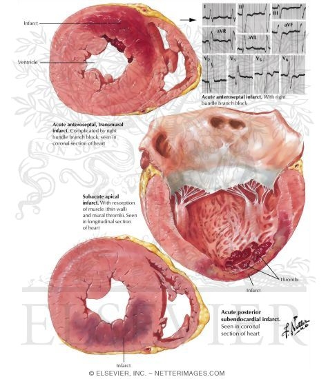 Watermarked preview of labeled image: Arteriosclerotic Heart Disease