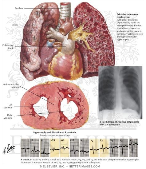 Chronic Cor Pulmonale