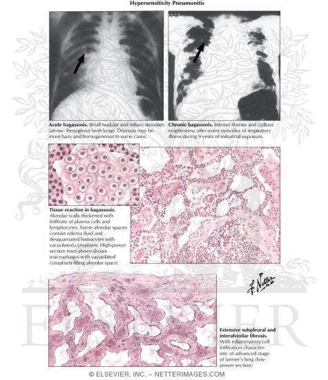 Watermarked preview of labeled image: Hypersensitivity Pneumonia
