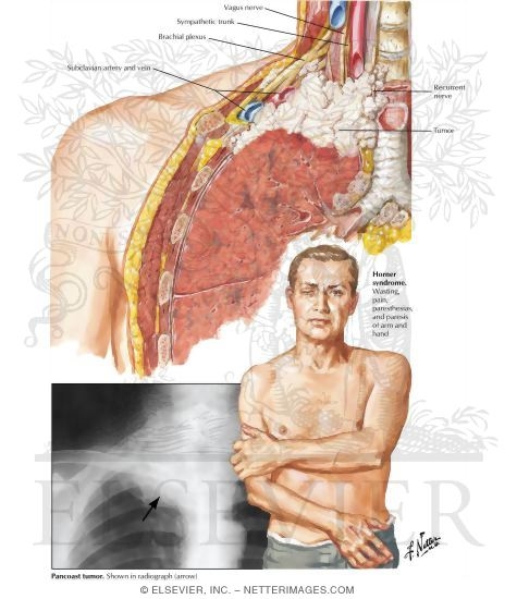 Pancoast's Syndrome