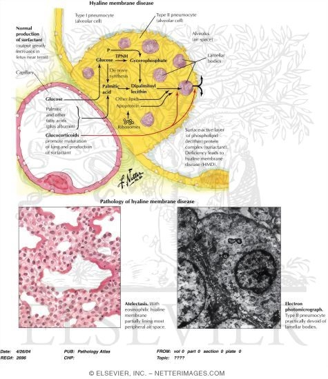 Hyaline Membrane Disease