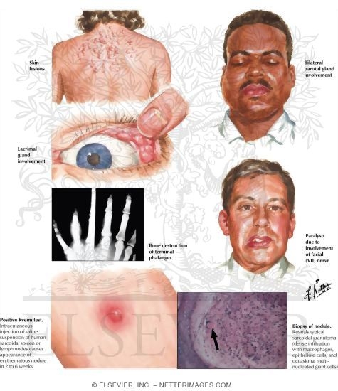 Sarcoidosis