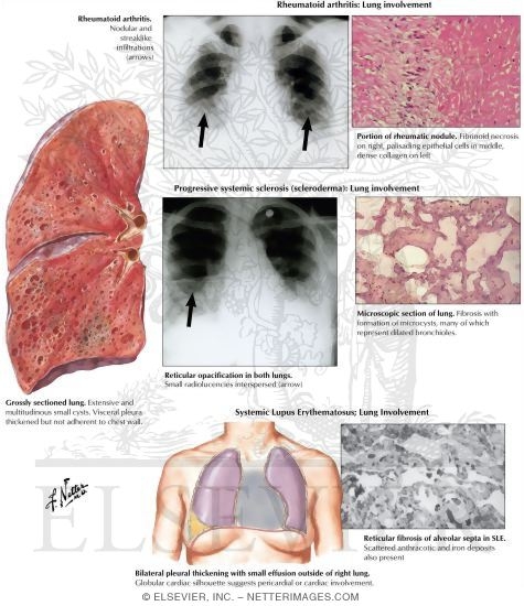Collagen Vascular Disease: Lung Involvement