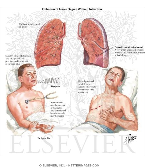 Pulmonary Embolism