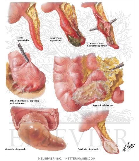 Diseases of the Appendix: Inflammation, Mucocele, Tumors