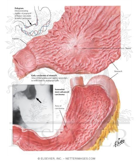 Watermarked preview of labeled image: Carcinoma of Stomach