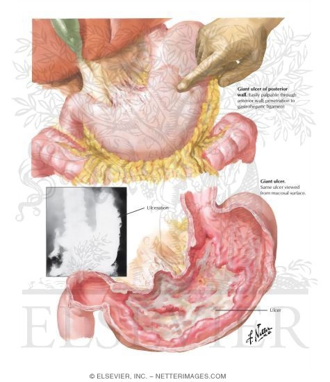 Watermarked preview of labeled image: Peptic Ulcer V - Giant Ulcer