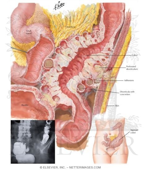 Watermarked preview of labeled image: Diverticulitis (Peridiverticular Fibrosis)