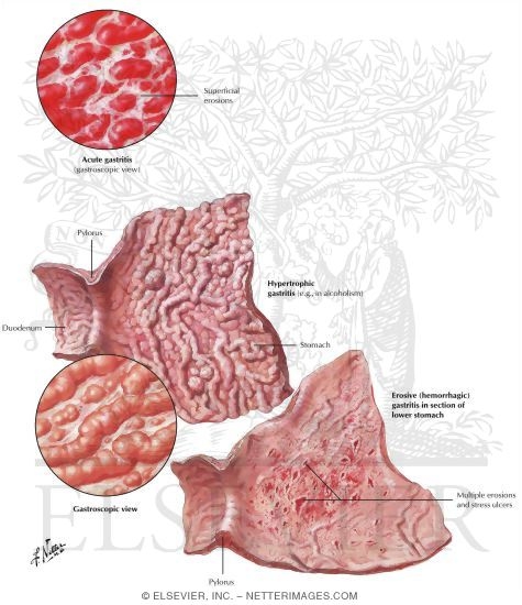 Watermarked preview of labeled image: Gastritis