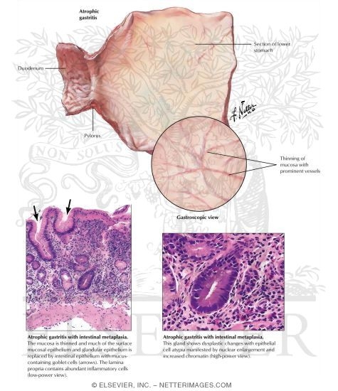 Watermarked preview of labeled image: Gastritis