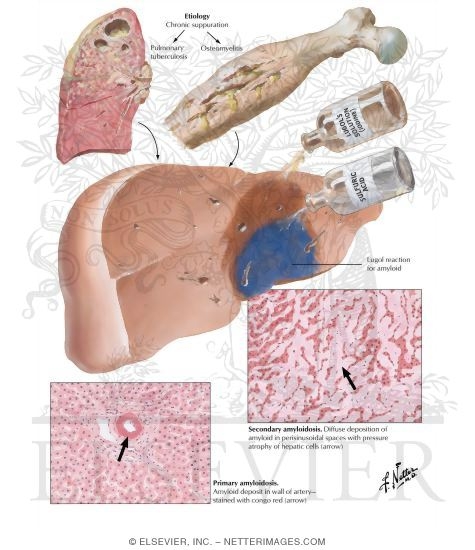 Watermarked preview of labeled image: Metabolic Injuries I - Amyloidosis