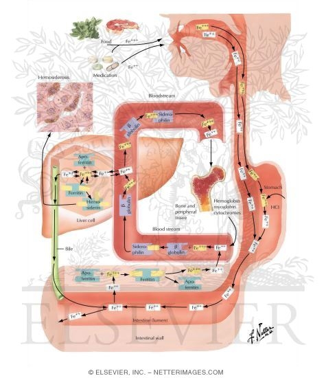 Hemosiderosis, Hemochromatosis