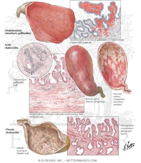 Cholecystitis I - Acute and Chronic