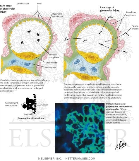 Watermarked preview of labeled image: Hypothesis of Pathogenesis of Chronic Glomerular Injury by Circulating Immune Complexes (Schematic)