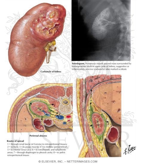 Renal Carbuncle and Perirenal Abscess